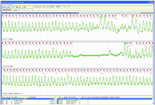 compressões torácicas batimentos cardíacos PCR