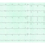 ECG--Eletrocardiograma-na-Prática