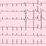 ECG - Eletrocardiograma na Emergência.