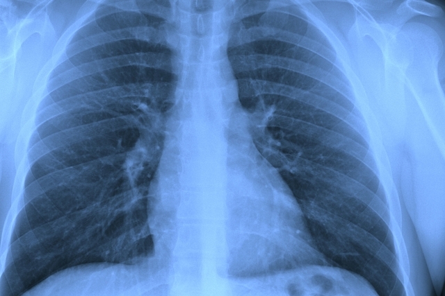 pulmão crítico dia mundial 