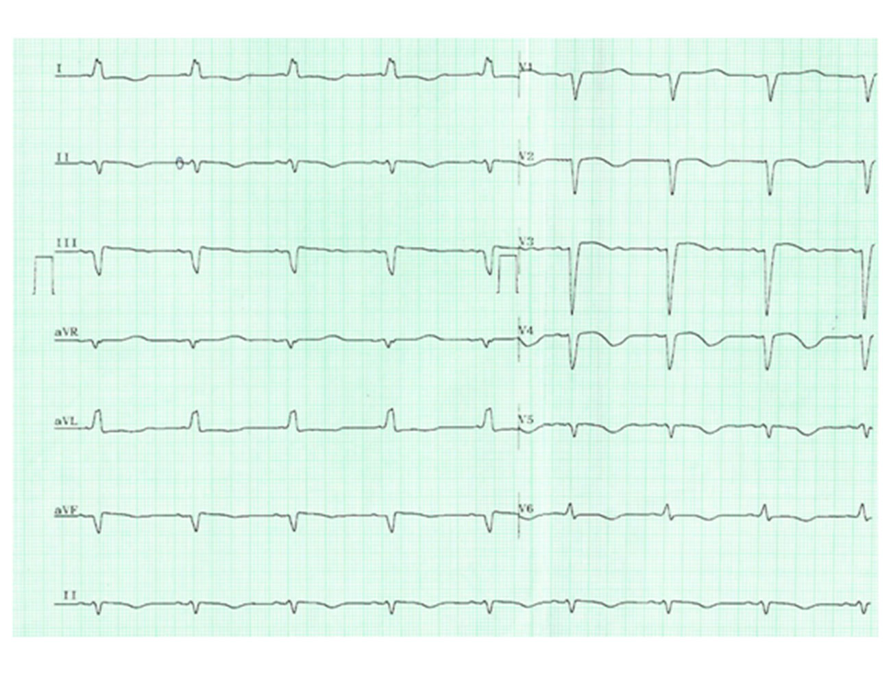 ECG--Eletrocardiograma-na-Prática